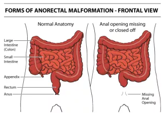 Anorectal Malformation (front view)