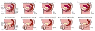 Forms of Anorectal Malformation (side view)