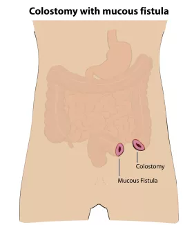 Colostomy with mucous fistula (external view)