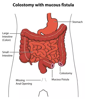 Colostomy with mucous fistula