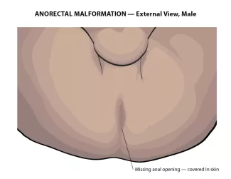 Anorectal Malformation (external view, male)