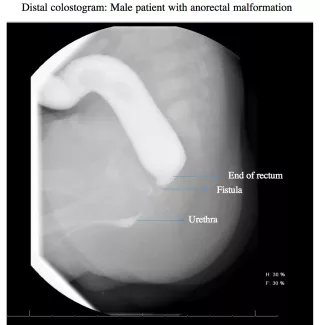 Distal colostogram: male patient with anorectal malformation