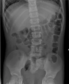 X-ray of clean colon