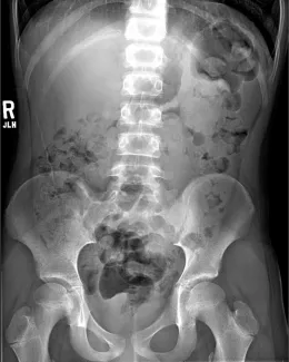 X-ray of constipated colon